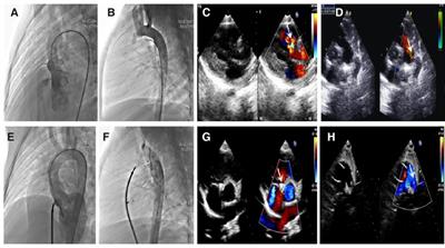 Clinical analysis and medium-term follow-up of simultaneous interventional therapy for compound congenital heart disease in children: a single-center retrospective study